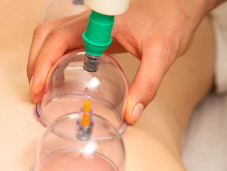 Cupping Therapy