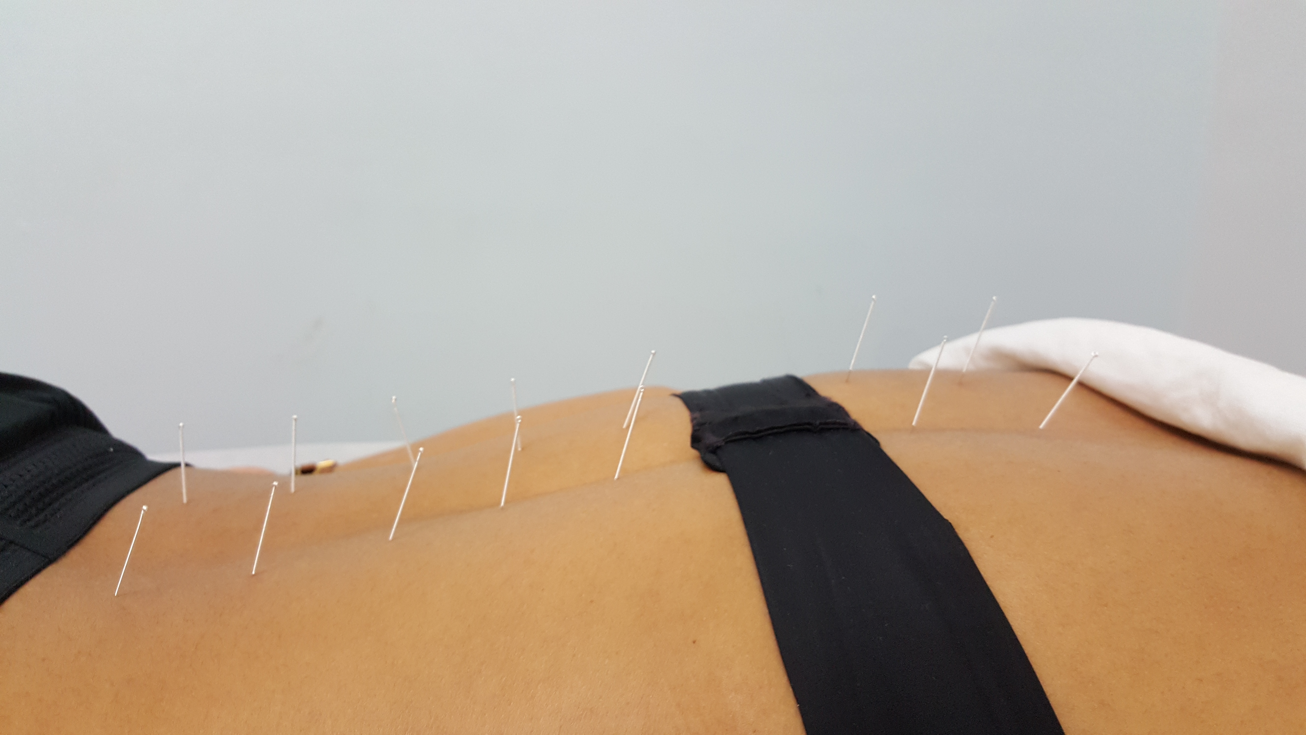 Dry Needling